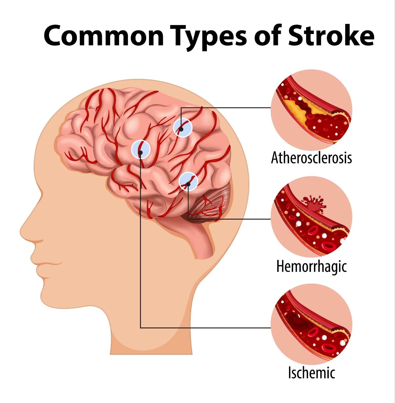 stroke iskemik adalah